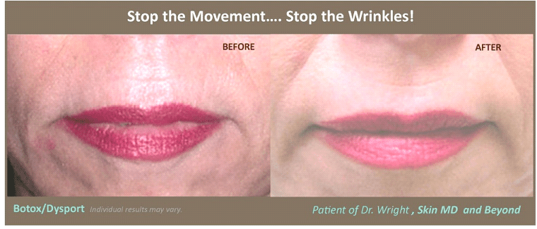 Before & After lip lines Frisco TX