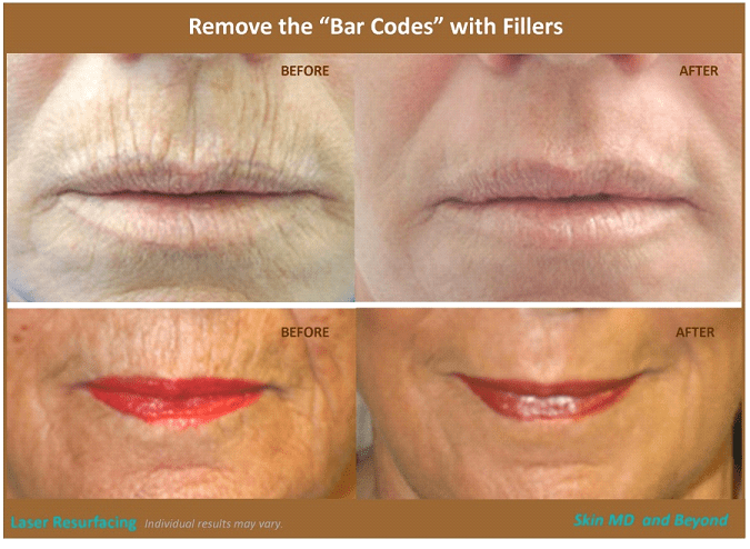 Before and after Lip Lines/Borders Frisco TX