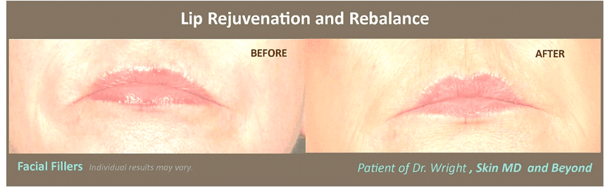 Before & After image of Asymmetric Lips Treatment Plano TX
