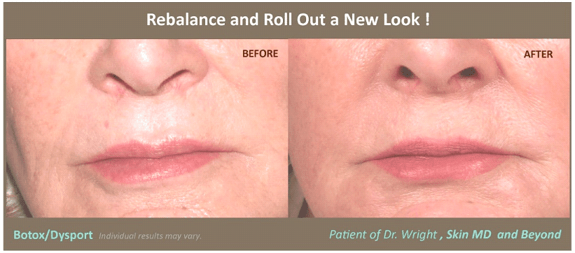 Before & After image of Asymmetric Lips Treatment Frisco TX