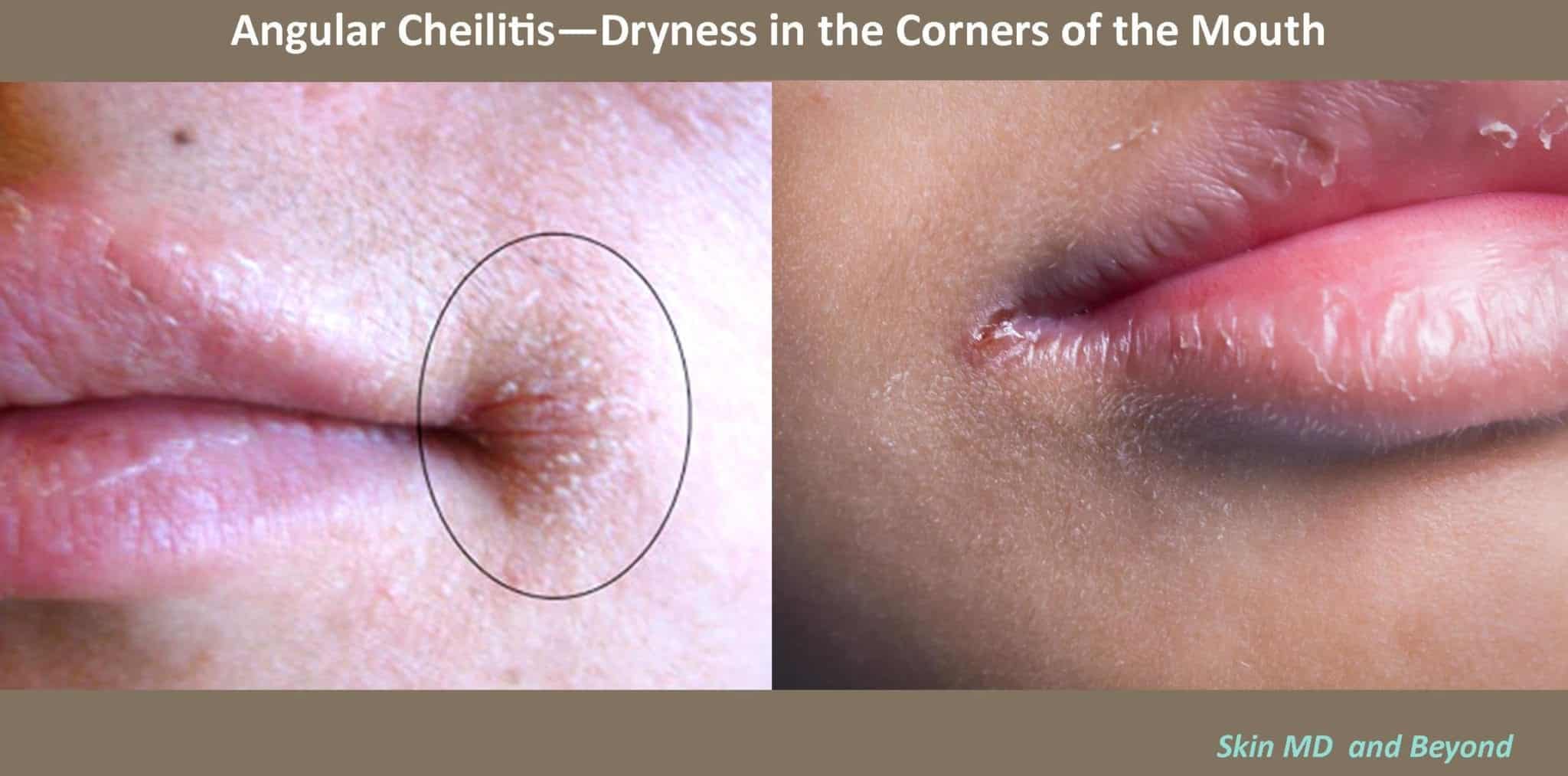 Dry, Rough Lips Treatment Plano TX Lip Rejuvenation Frisco TX