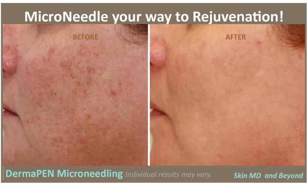 MicroNeedle your way to Rejuvenation! DermaPEN