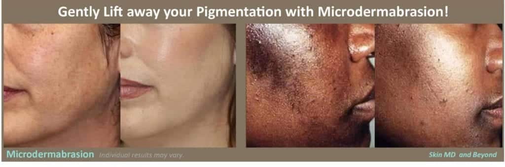 Microdermabrasion