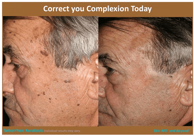 Before & After image of Actinic Keratosis Removal Frisco TX
