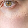 Milia (Milium) - pimples around eye on skin.