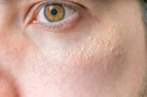 Milia (Milium) - pimples around eye on skin.