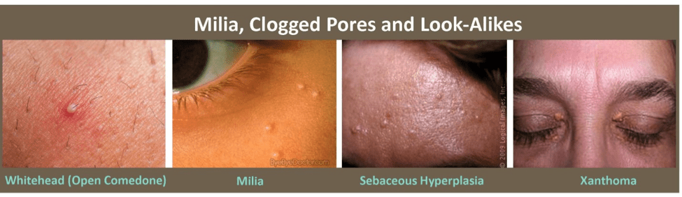 After & Before image of Milia Treatment Plano TX