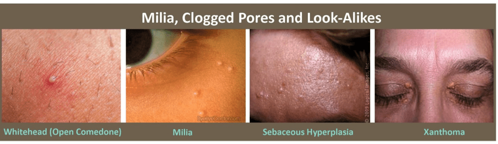 Milia Treatment Plano TX Clogged Pores Treatment Frisco TX.