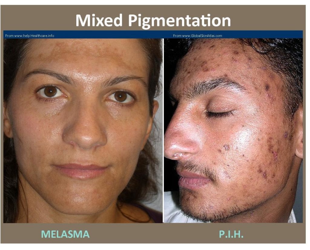 Mixed Pigmentation