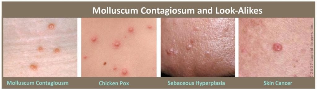 molluscum-contagiosum-look-alikes