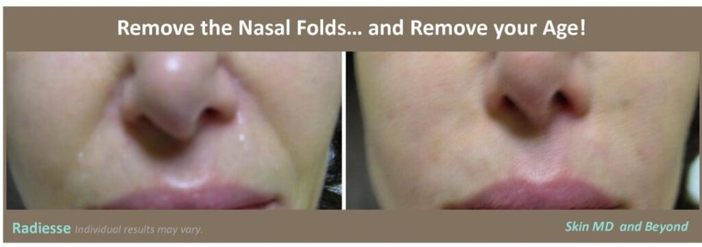 nasal-folds