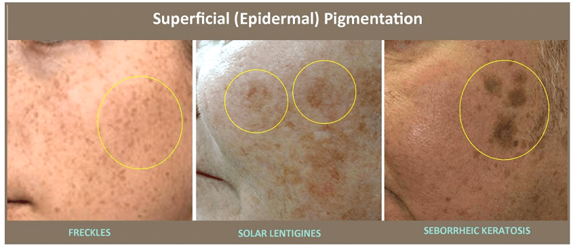 Spots 101: Your Ultimate Guide to Differentiating Pigmentation