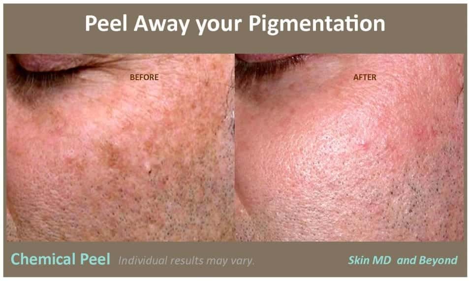 Peel Away Your Pigmentation Chemical Peel