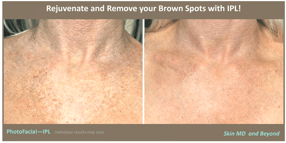 Before & After Image of Neck Rejuvenation IPL Photofacial Plano TX