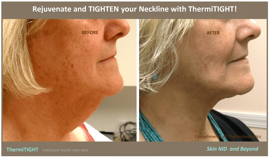 Before & After Image of Neckline Rejuvenation Frisco TX