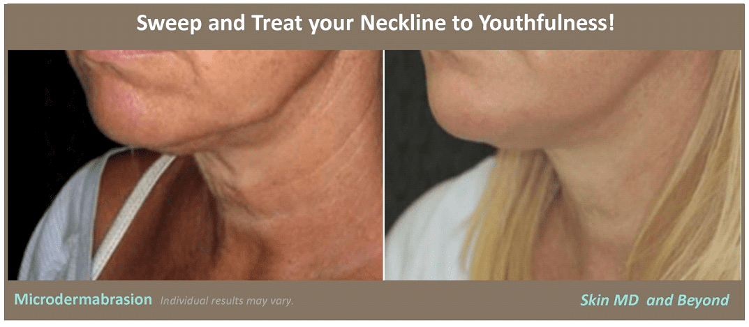 Before & After Image of Facial Rejuvenation Plano TX