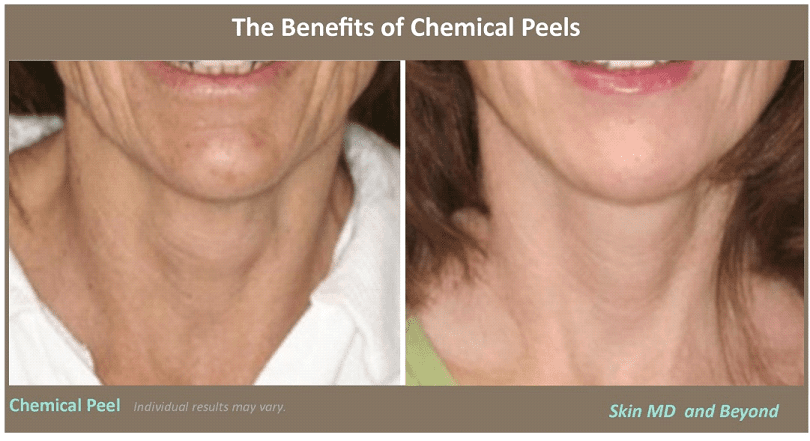 Before & After Image of Chemical Peel Treatment Frisco TX