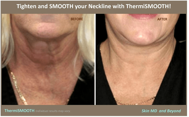 Before & After Image of Neckline Rejuvenation Plano TX