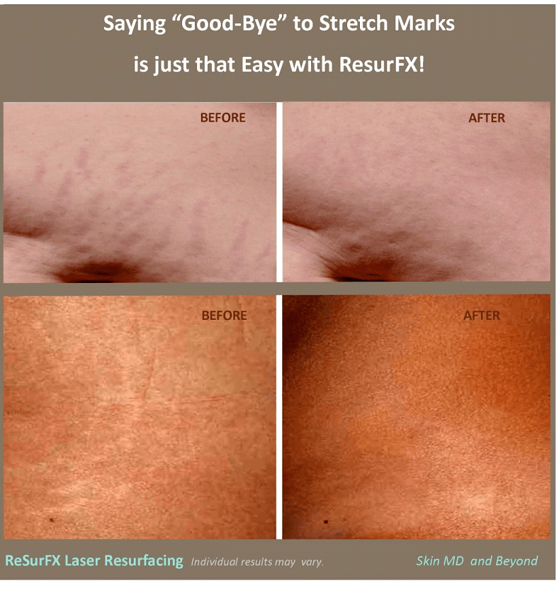 Before & After Image of Stretch Marks Treatment Frisco TX