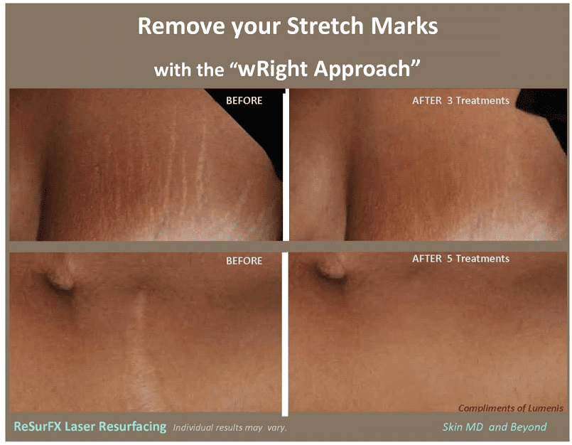 Stretch Marks Treatments Plano, TX | Scar Treatment | Skin MD & Beyond