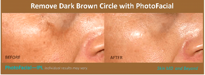 Hand Rejuvenation Plano TX | Injectables Frisco TX | Skin Care