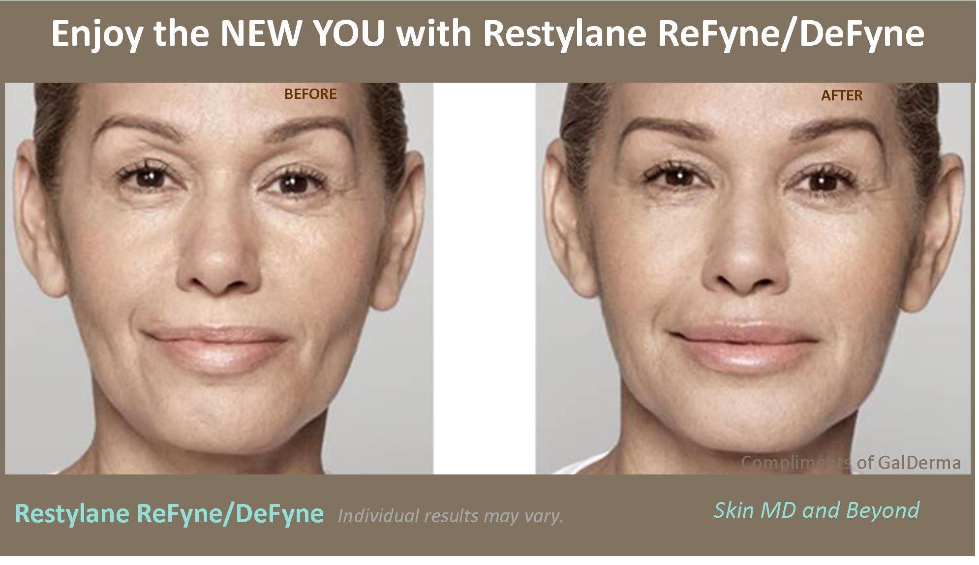 Restylane ReFyne Plano TX