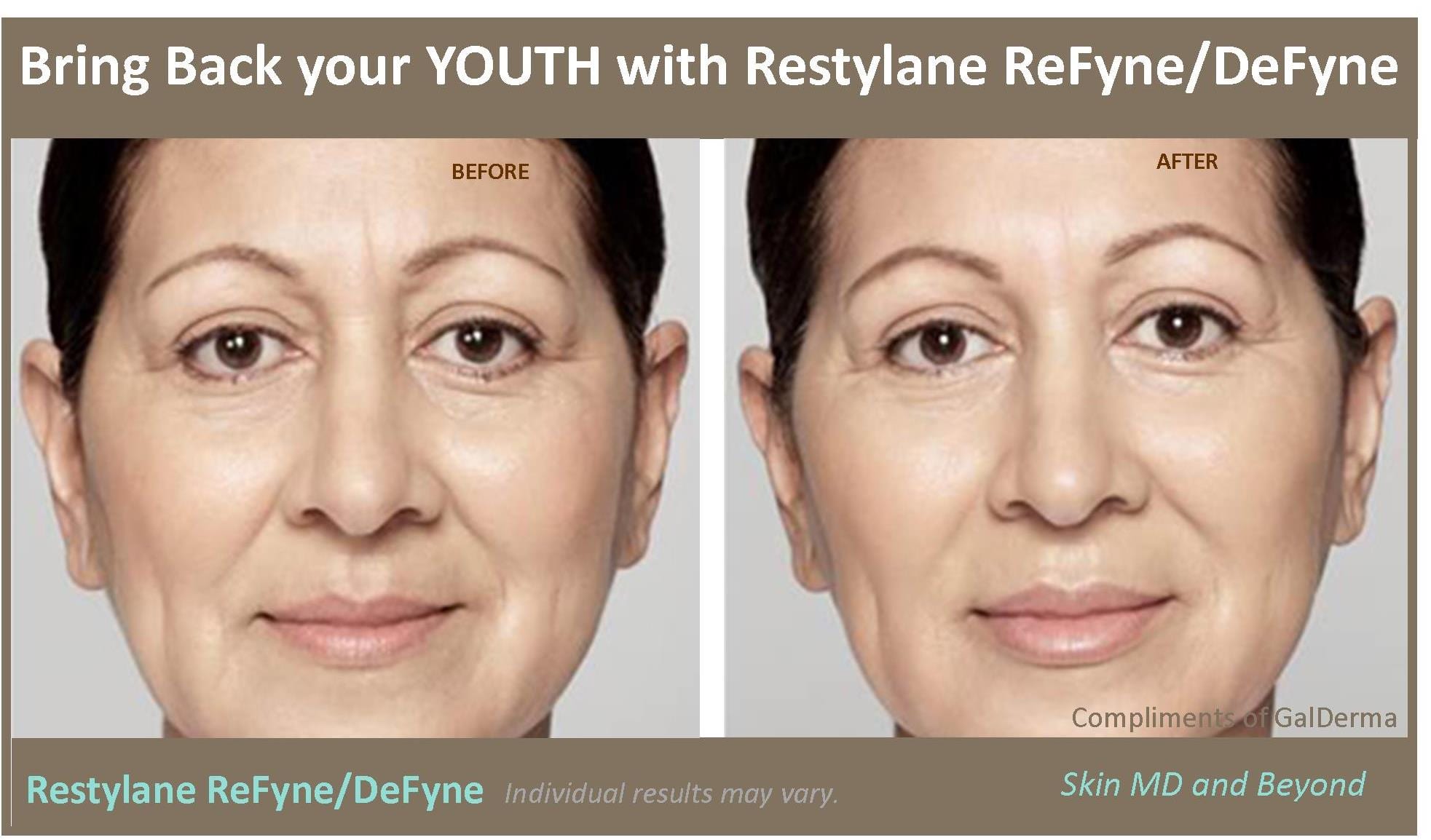 Restylane ReFyne Plano TX