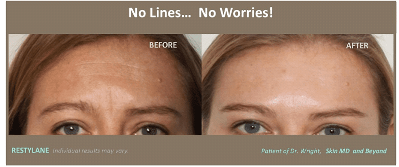 Before & After Restylane Frisco TX