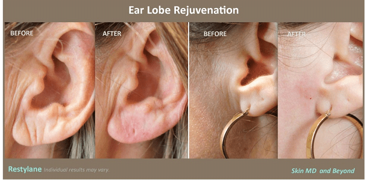 Before & After Restylane Plano TX
