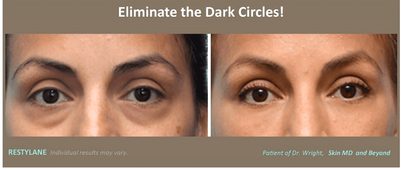 Before & After Restylane Treatment Plano TX