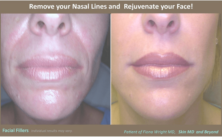 Before & After Nasal Lines Plano 