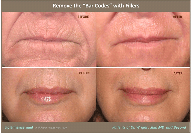 Before & After Restylane Silk Plano 