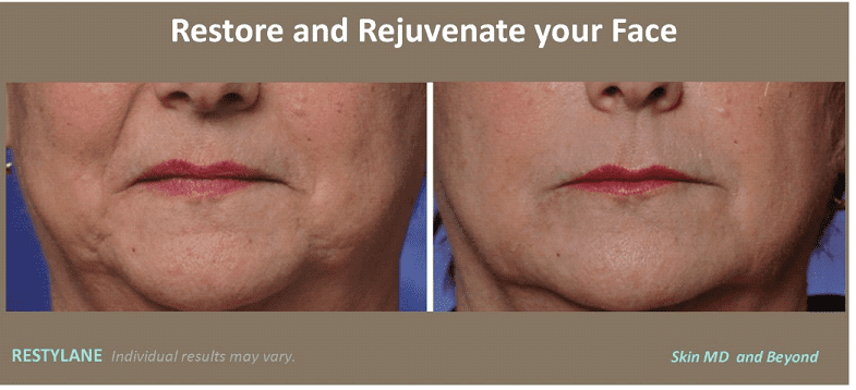 Before & After Restylane Silk Frisco TX