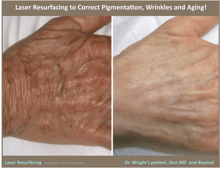 ResurFX Laser Resurfacing