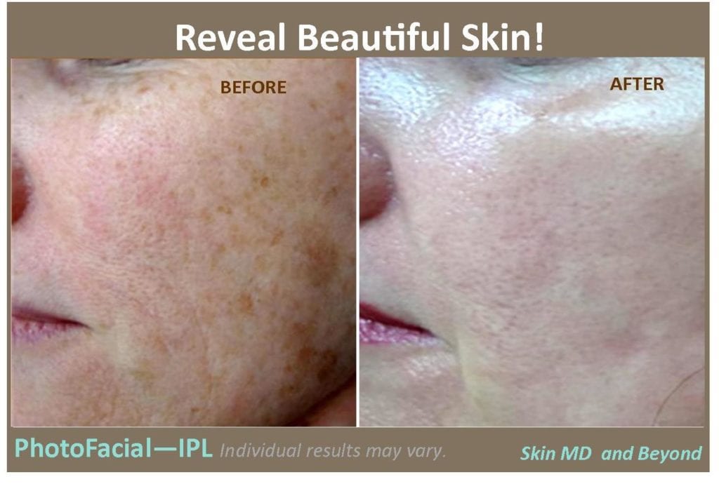 Reveal Beautiful Skin! PhotoFacial-IPL