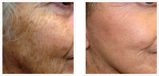 laser skin resurfacing