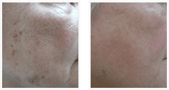 laser resurfacing in texas