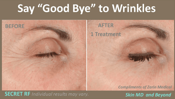 Radiofrequency Needling Dallas Fort Worth TX