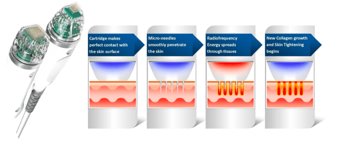 Radiofrequency Needling Dallas Fort Worth TX