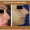 Squint and Nasal Lines (2)