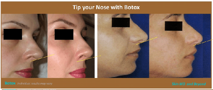 Before & After image of Nose Botox Plano TX