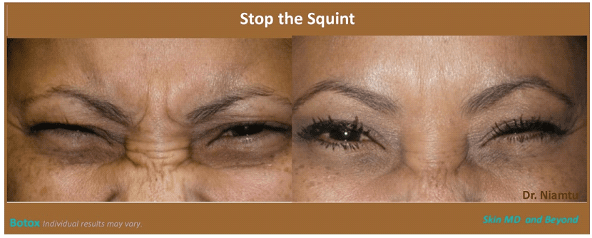 Before & After image of Nose Rejuvenation Frisco TX
