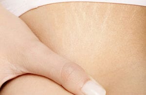 Stretch Marks after Pregnancy