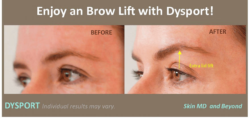 Before & After Brow Lift Frisco TX