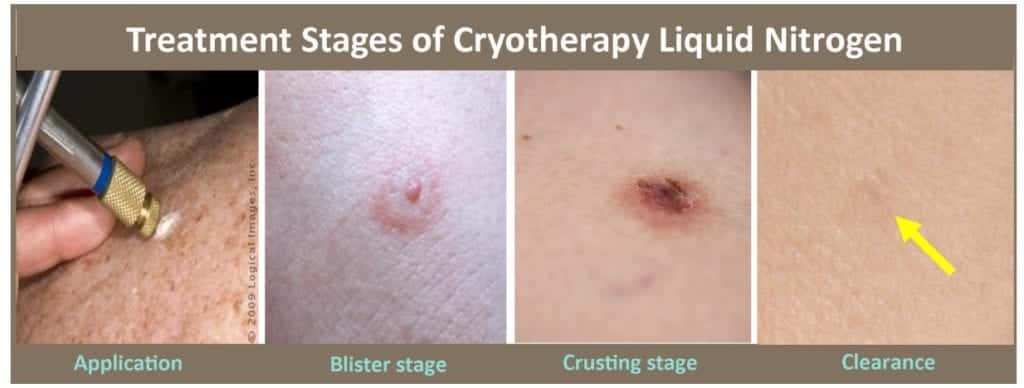 Treatment Stages of Cryotherapy Liquid Nitrogen