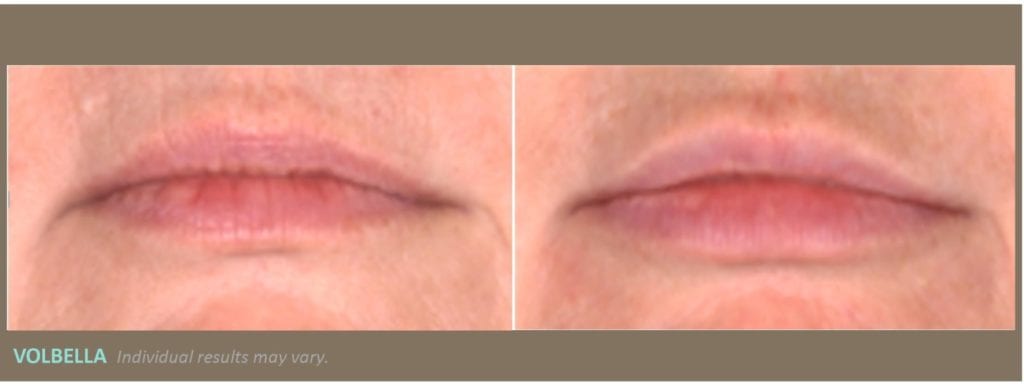 woman’s lips before and after volbella treatment, lips fuller with less wrinkles after treatment