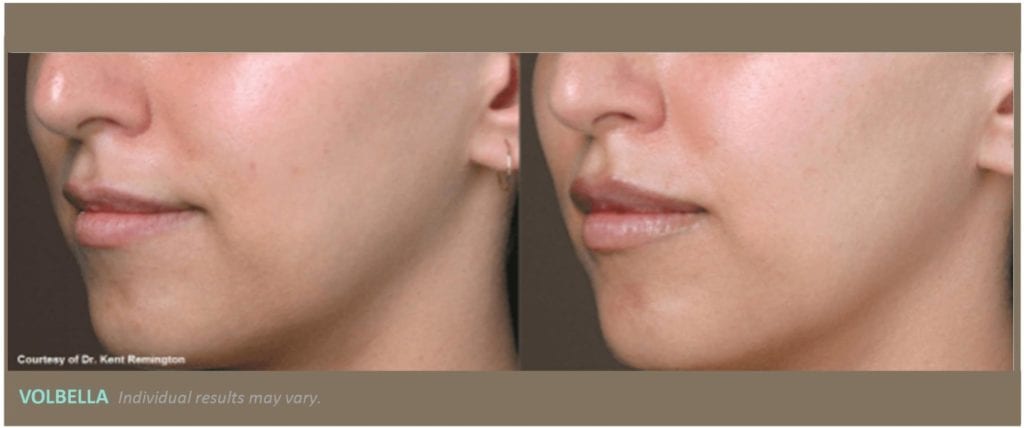 side view of woman’s lips before and after volbella treatment, lips fuller with less wrinkles after treatment