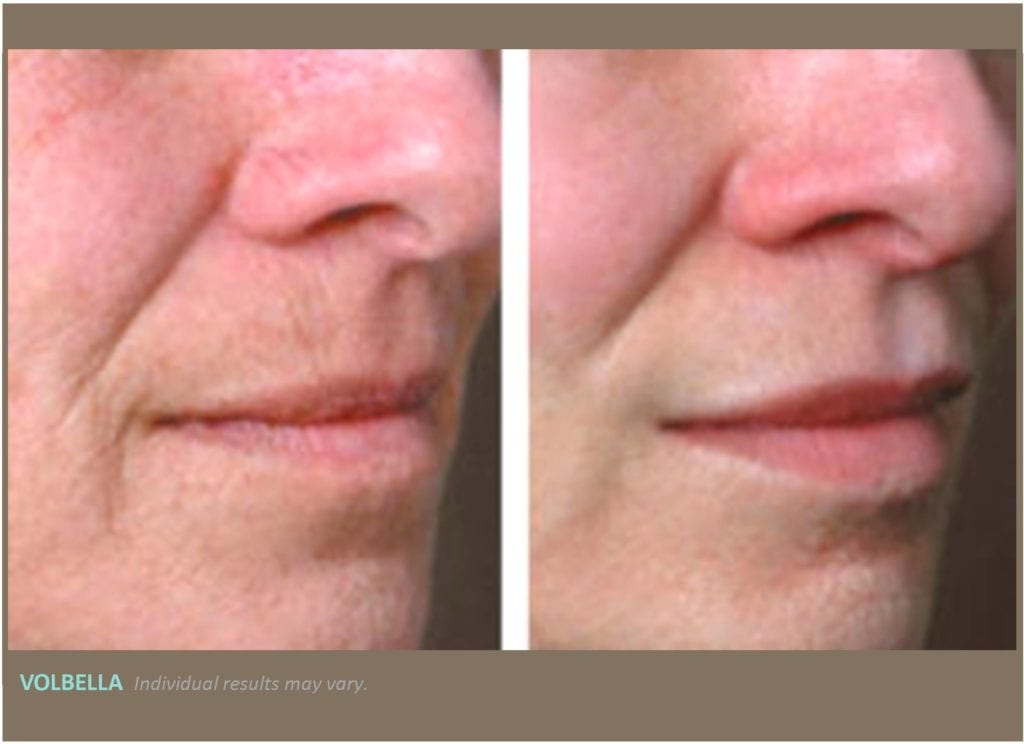  side view of older woman’s lips before and after volbella treatment, lips fuller with less wrinkles after treatment