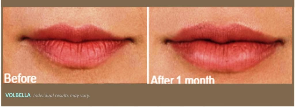 red lips before and one month after volbella treatment