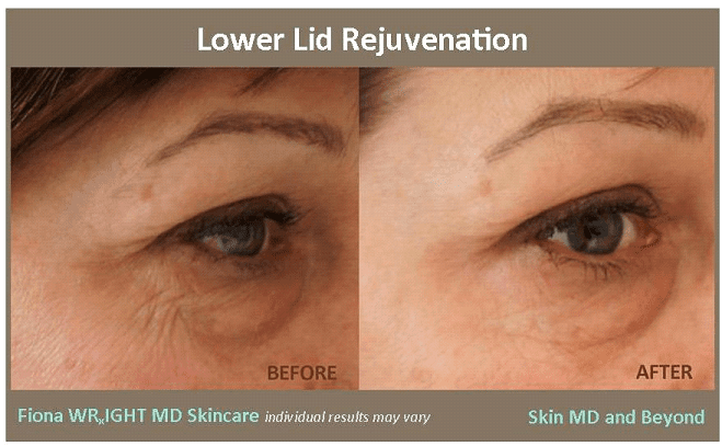 Before & After image of Wrinkles Treatment Plano TX